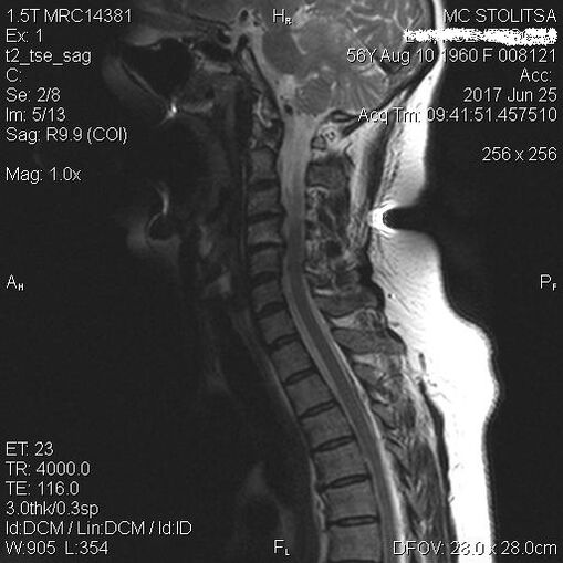 Gimdos kaklelio stuburo osteochondrozė ir spondilozė