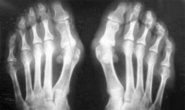 Diferencinė artrito ir artrozės simptomų diagnozė